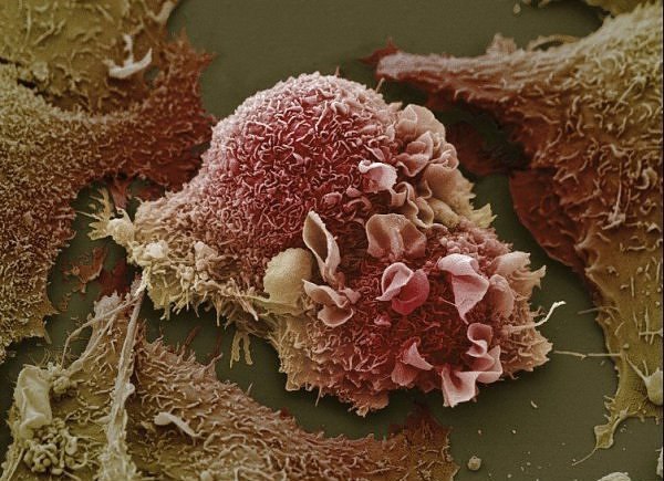 Рак – это грибковое заболевание… и оно излечимо